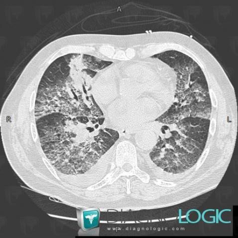 Hémorragie intra alvéolaire, Parenchyme pulmonaire, Scanner