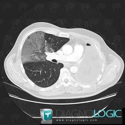 Hémorragie intra alvéolaire, Parenchyme pulmonaire, Scanner