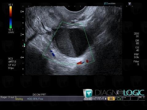 Radiology case : Hemorrhagic cyst (US) - Diagnologic