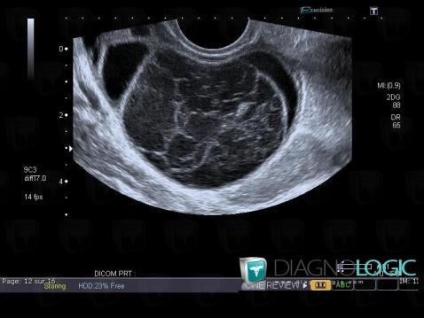 Radiology case : Hemorrhagic cyst (US) - Diagnologic