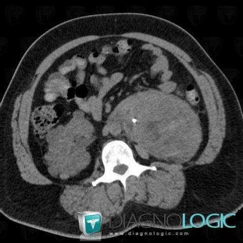 Hemorrhagic renal cyst, Kidney, CT