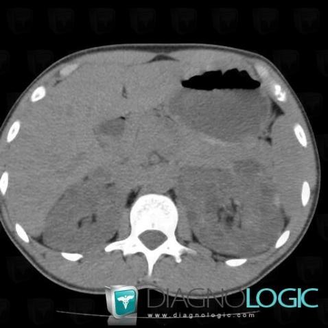 Hemorrhagic renal cyst, Kidney, CT