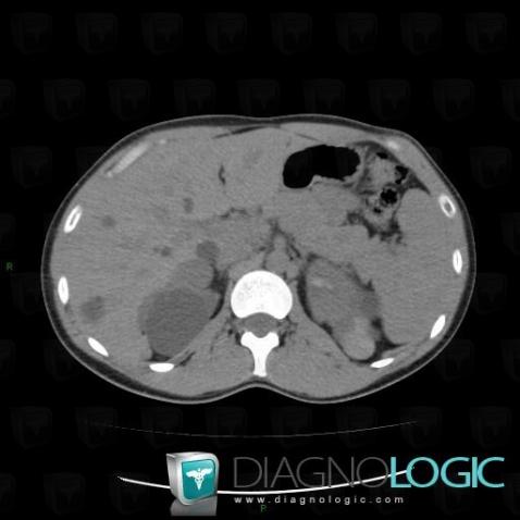 Hemorrhagic renal cyst, Kidney, CT