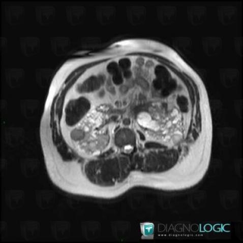 Hemorrhagic renal cyst, Kidney, MRI