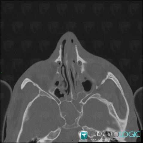 Radiology Case : Hemosinus (ct) - Diagnologic