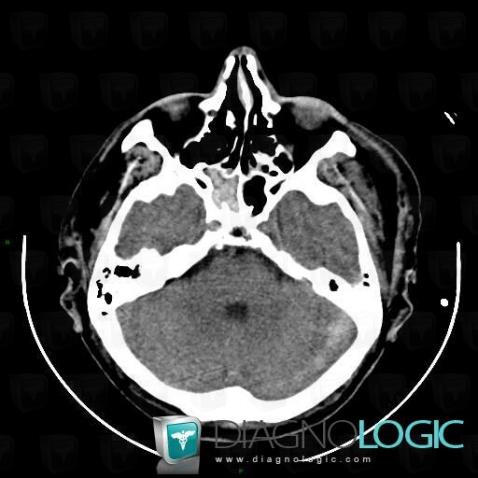 Hemosinus, Sinus, CT