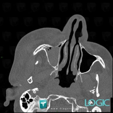 Radiology case : Hemosinus (CT) - Diagnologic