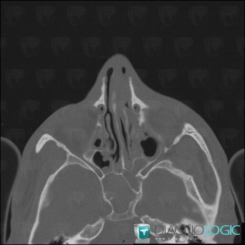 Hemosinus, Sinus, Scanner