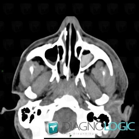 Hemosinus, Sinus, Scanner