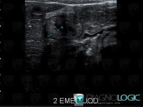 Henoch-Schönlein purpura, Duodenum, US