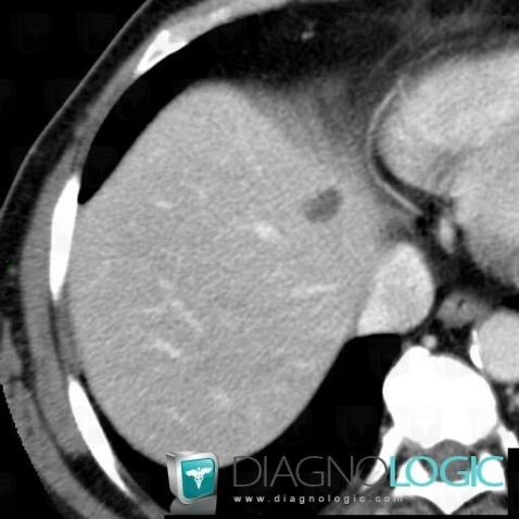 Hepatic cyst, Liver, CT