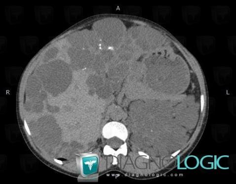 Hepatic cyst, Liver, CT