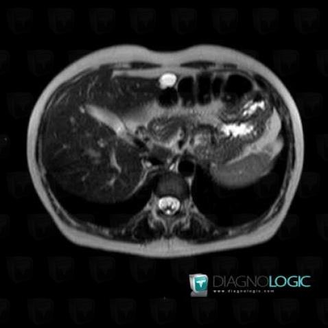 Hepatic cyst, Liver, MRI