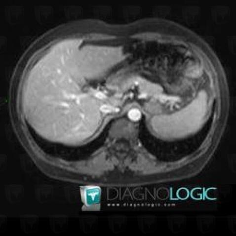 Hepatic cyst, Liver, MRI