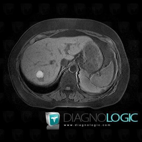 Hepatic cyst, Liver, MRI