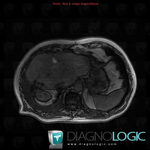 Hepatic cyst, Liver, MRI