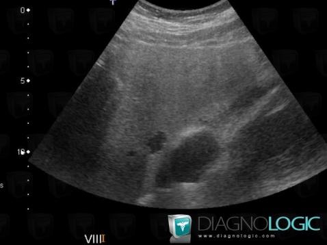 Hepatic cyst, Liver, US