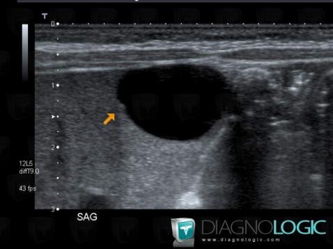 Hepatic cyst, Liver, US