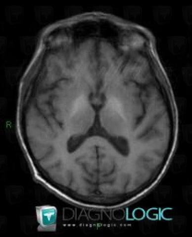 Radiology case : Hepatic failure (MRI) - Diagnologic