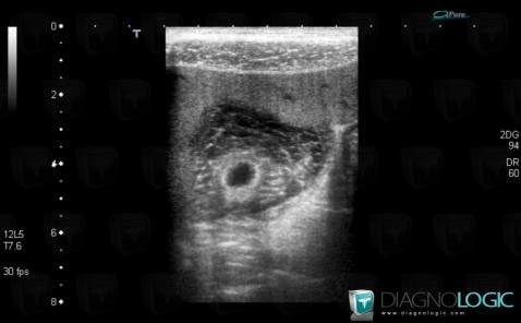 Hépatite aiguë, Vésicule biliaire, Echographie