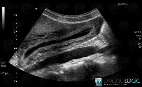 Hépatite aiguë, Vésicule biliaire, Echographie
