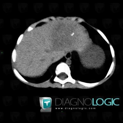 Hepatoblastoma, Liver, CT