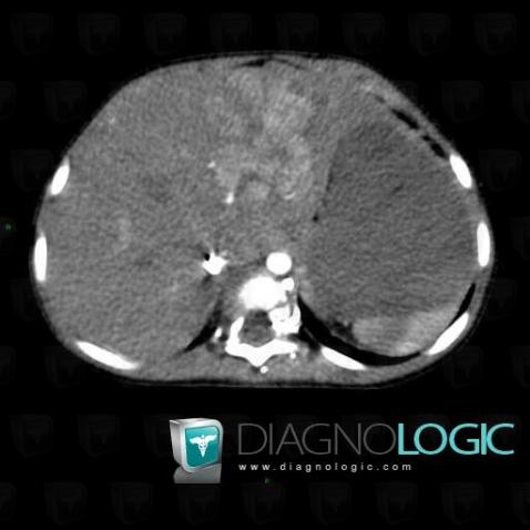 Hepatoblastoma, Liver, CT