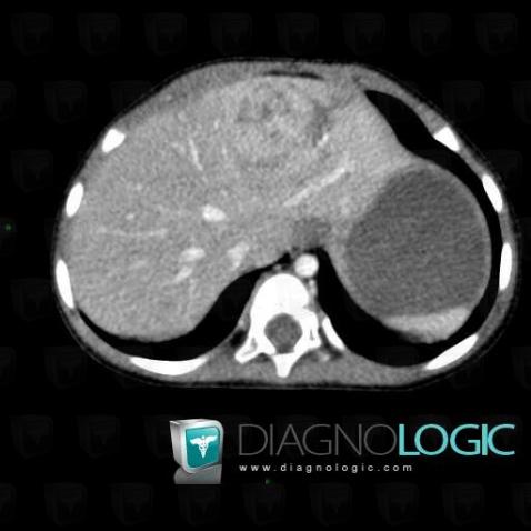 Hepatoblastoma, Liver, CT