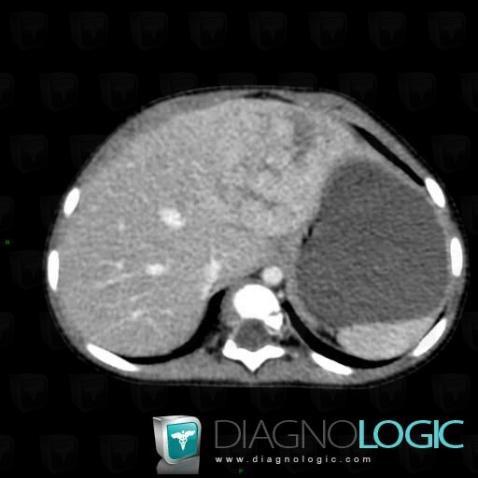 Hepatoblastoma, Liver, CT