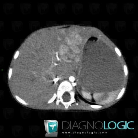 Hepatoblastoma, Liver, CT