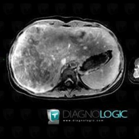 Hepatoblastoma, Liver, MRI