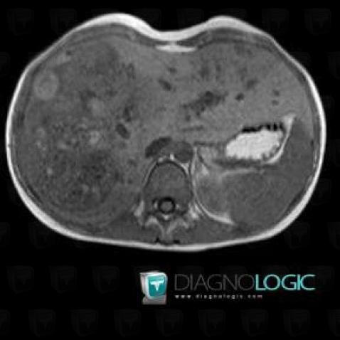 Hepatoblastoma, Liver, MRI