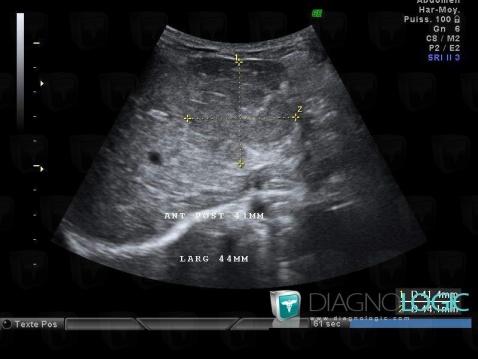 Hepatoblastoma, Liver, US