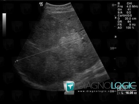 Hepatoblastoma, Liver, US