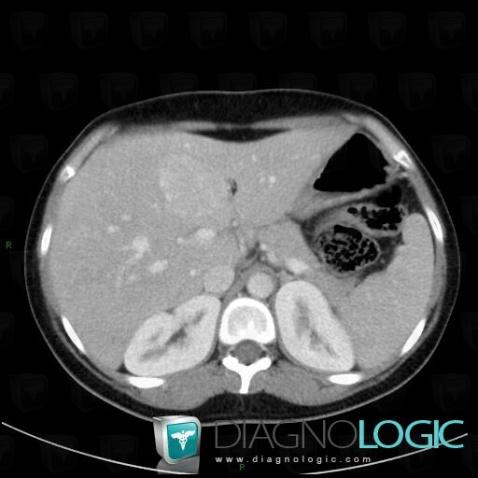 Hepatocellular adenoma, Liver, CT