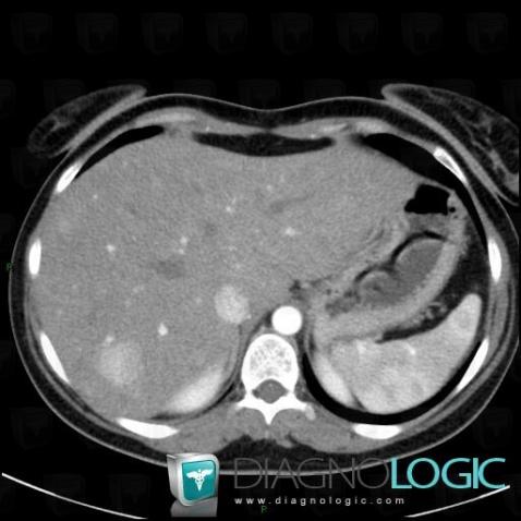 Hepatocellular adenoma, Liver, CT