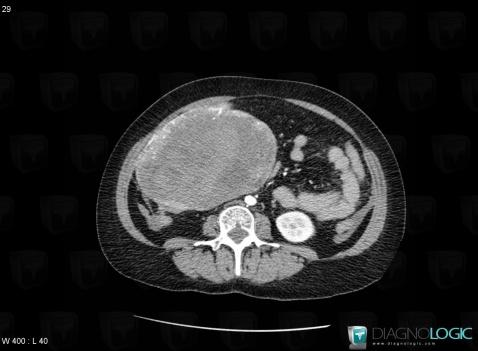 Hepatocellular adenoma, Liver, CT