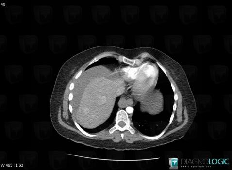 Hepatocellular adenoma, Liver, CT