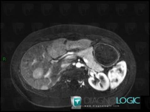 Hepatocellular adenoma, Liver, MRI