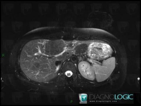 Hepatocellular adenoma, Liver, MRI