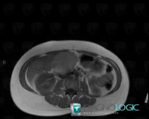 Hepatocellular adenoma, Liver, MRI