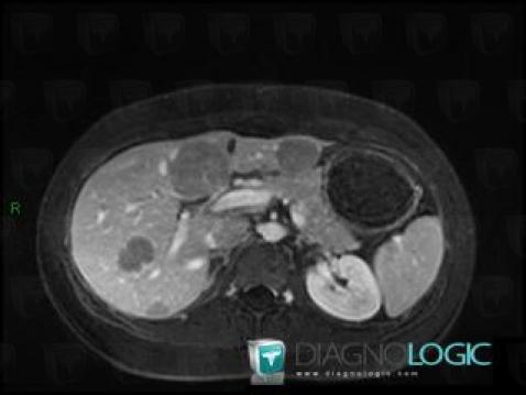 Hepatocellular adenoma, Liver, MRI