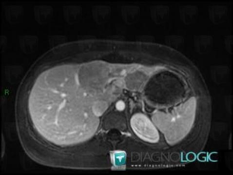 Hepatocellular adenoma, Liver, MRI