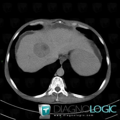 Hepatocellular carcinoma, Liver, CT