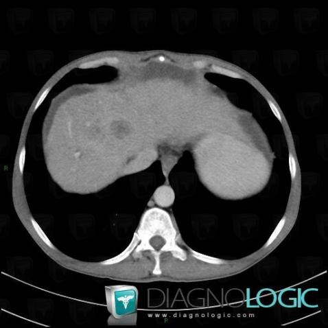 Hepatocellular carcinoma, Liver, CT