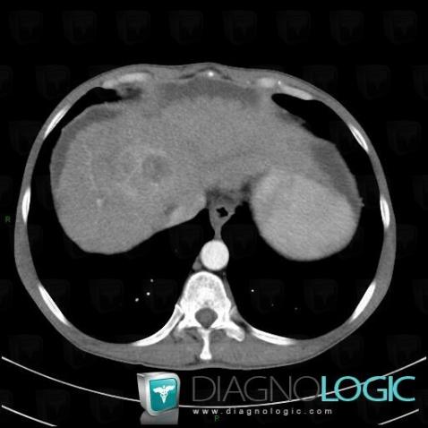 Hepatocellular carcinoma, Liver, CT