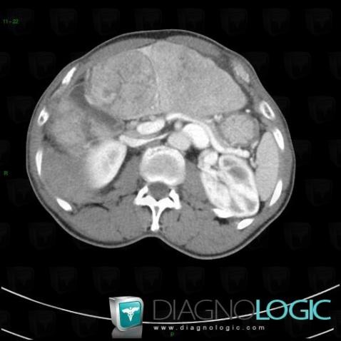 Hepatocellular carcinoma, Liver, CT