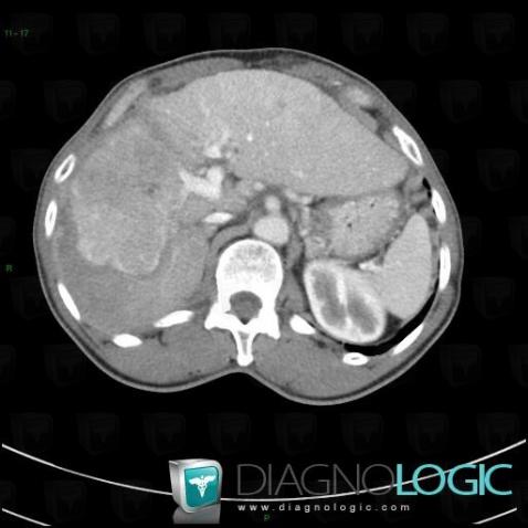 Hepatocellular carcinoma, Liver, CT