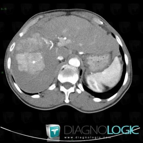 Hepatocellular carcinoma, Liver, CT