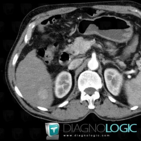 Hepatocellular carcinoma, Liver, CT